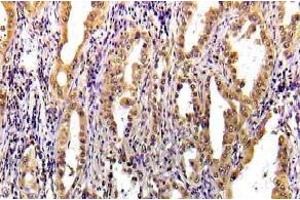 Immunohistochemistry (IHC) analyzes of STAT3 pAb in paraffin-embedded human lung carcinoma tissue. (STAT3 Antikörper)