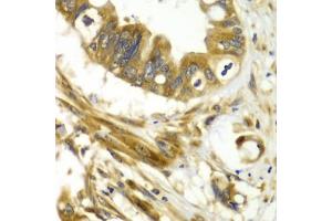 Immunohistochemistry of paraffin-embedded human liver cancer using GBP1 antibody (ABIN6293142) at dilution of 1:100 (40x lens). (GBP1 Antikörper)