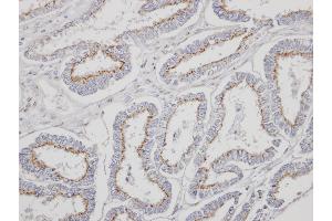 Immunohistochemical staining of paraffin-embedded Endometrial CA using YIPF4 antibody at a dilution of 1:500