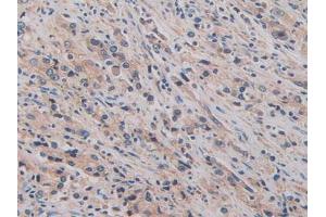 IHC-P analysis of Human Prostate Gland Cancer Tissue, with DAB staining. (CD147 Antikörper  (AA 79-280))