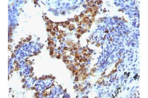 Formalin-fixed, paraffin-embedded human Lung Adenocarcinoma stained with Napsin-A Monoclonal Antibody (NAPSA/1238 + NAPSA/1239). (NAPSA Antikörper  (AA 189-299))