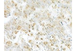 ABIN6264754 and ABIN6273309 at 1/100 staining human melanoma by IHC-P. (RIC8B Antikörper  (C-Term))