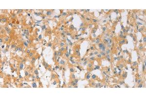 Immunohistochemistry of paraffin-embedded Human thyroid cancer using EPS15L1 Polyclonal Antibody at dilution of 1:30 (EPS15L1 Antikörper)
