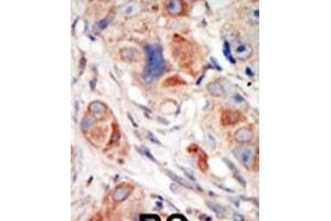 Formalin-fixed and paraffin-embedded human cancer tissue reacted with the primary antibody, which was peroxidase-conjugated to the secondary antibody, followed by DAB staining. (PIK3CD Antikörper  (C-Term))