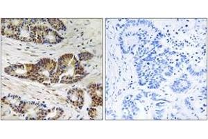 Immunohistochemistry analysis of paraffin-embedded human colon carcinoma tissue, using GRK2 (Ab-685) Antibody. (GRK2 Antikörper  (AA 640-689))