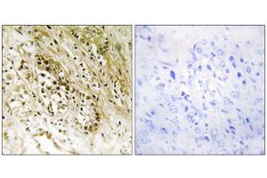 Immunohistochemistry analysis of paraffin-embedded human prostate carcinoma tissue, using PDZD2 antibody. (PDZD2 Antikörper  (N-Term))
