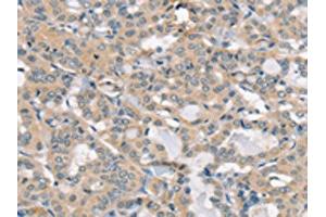 The image on the left is immunohistochemistry of paraffin-embedded Human thyroid cancer tissue using ABIN7192520(SLC6A8 Antibody) at dilution 1/30, on the right is treated with synthetic peptide. (SLC6A8 Antikörper)