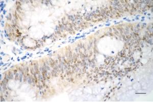 Immunohistochemistry was performed on paraffin-embedded human sigmoid colon carcinoma using p21 antibody (ABIN7798222), 1:200). (Rekombinanter p21 Antikörper)