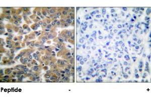Immunohistochemical analysis of paraffin-embedded human breast carcinoma tissue using NR3C1 polyclonal antibody . (Glucocorticoid Receptor Antikörper)
