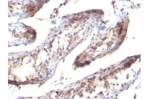 Formalin-fixed, paraffin-embedded human Testicular Carcinoma stained with TGF alpha Mouse Monoclonal Antibody (SPM357) (TGFA Antikörper  (C-Term))