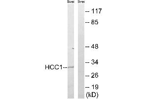 Immunohistochemistry analysis of paraffin-embedded human breast carcinoma tissue, using HCC1 antibody. (RBM39 Antikörper  (Internal Region))