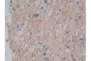 DAB staining on IHC-P; Samples: Human Glioma Tissue (Plexin A1 Antikörper  (AA 43-300))