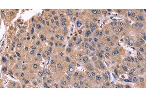 Immunohistochemistry of paraffin-embedded Human liver cancer tissue using CSNK1D Polyclonal Antibody at dilution 1:50 (Casein Kinase 1 delta Antikörper)