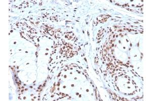 Formalin-fixed, paraffin-embedded human Basal Cell Carcinoma stained with Nucleophosmin Mouse Monoclonal Antibody (NPM1/3286). (NPM1 Antikörper  (AA 185-287))