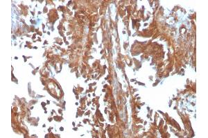 Formalin-fixed, paraffin-embedded human Urothelial Carcinoma stained with PAI-RBP1 Mouse Monoclonal Antibody (SERBP1/3497). (SERBP1 Antikörper  (AA 3-139))
