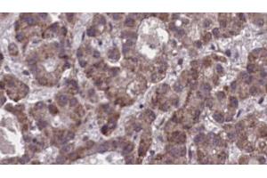 ABIN6273900 at 1/100 staining Human liver cancer tissue by IHC-P. (Purinergic Receptor P2Y, G-Protein Coupled, 13 (P2RY13) (C-Term) Antikörper)