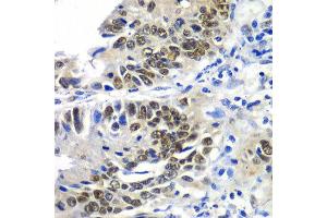 Immunohistochemistry of paraffin-embedded human colon carcinoma using DACH1 antibody at dilution of 1:100 (x40 lens). (DACH1 Antikörper)