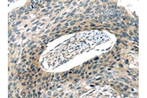 The image on the left is immunohistochemistry of paraffin-embedded Human esophagus cancer tissue using ABIN7193008(VAMP2 Antibody) at dilution 1/20, on the right is treated with synthetic peptide. (VAMP2 Antikörper)