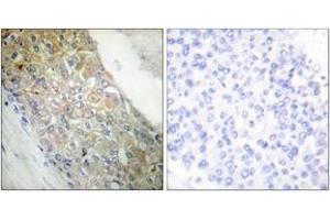 Immunohistochemistry analysis of paraffin-embedded human breast carcinoma tissue, using IR (Ab-1355) Antibody. (IR (AA 1326-1375) Antikörper)