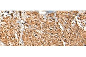 Immunohistochemistry of paraffin-embedded Human prost ate cancer tissue using MICU1 Polyclonal Antibody at dilution of 1:35(x200) (MICU1 Antikörper)