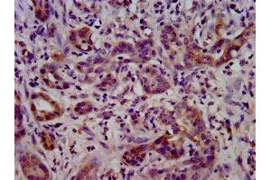 IHC image of ABIN7158426 diluted at 1:400 and staining in paraffin-embedded human pancreatic cancer performed on a Leica BondTM system. (LSR Antikörper  (AA 112-233))