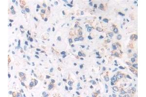 Detection of ECH1 in Human Prostate cancer Tissue using Polyclonal Antibody to Enoyl Coenzyme A Hydratase 1, Peroxisomal (ECH1)