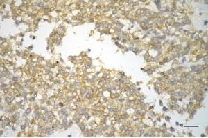 Immunohistochemistry was performed on paraffin-embedded human breast carcinoma using protein regulator of cytokinesis 1 antibody (ABIN7800037), 1:200). (Rekombinanter PRC1 Antikörper)