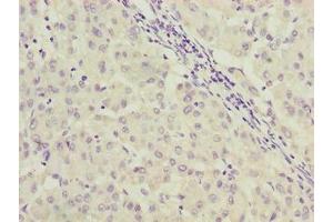 Immunohistochemistry of paraffin-embedded human liver cancer using ABIN7166922 at dilution of 1:100 (C9orf64 Antikörper  (AA 182-341))