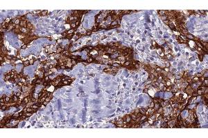 ABIN6277723 at 1/100 staining Human Head and neck cancer tissue by IHC-P. (SLC2A2 Antikörper  (N-Term))