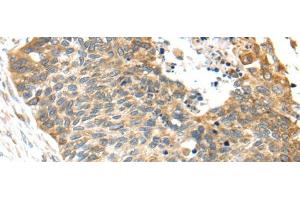 Immunohistochemistry of paraffin-embedded Human esophagus cancer tissue using TNFAIP8 Polyclonal Antibody at dilution 1:35 (TNFAIP8 Antikörper)