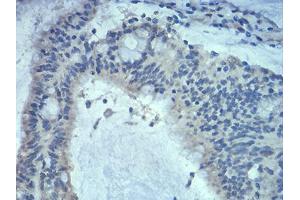 Immunohistochemical analysis of paraffin-embedded colon cancer tissues using Rab5a mouse mAb with DAB staining. (RAB5 Antikörper  (AA 1-215))