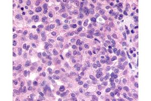 Anti-GPR98 / VLGR1 antibody IHC of human Ovary, Carcinoma. (ADGRV1 / GPR98 Antikörper  (N-Term))