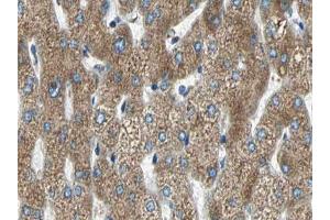 ABIN6266590 at 1/100 staining human liver carcinoma tissue sections by IHC-P.