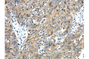 The image on the left is immunohistochemistry of paraffin-embedded Human breast cancer tissue using ABIN7131402(TMPRSS13 Antibody) at dilution 1/30, on the right is treated with fusion protein. (TMPRSS13 Antikörper)