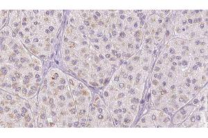 ABIN6278027 at 1/100 staining Human melanoma tissue by IHC-P. (FGA Antikörper  (C-Term))