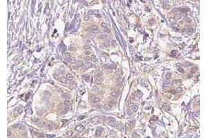 ABIN6275873 at 1/100 staining Human breast cancer tissue by IHC-P. (HMMR Antikörper  (Internal Region))
