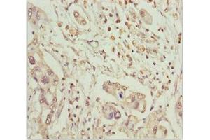 Immunohistochemistry of paraffin-embedded human pancreatic cancer using ABIN7159626 at dilution of 1:100 (MCCC2 Antikörper  (AA 284-563))