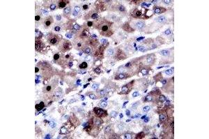 Immunohistochemical analysis of XPC staining in human liver cancer formalin fixed paraffin embedded tissue section. (XPC Antikörper)