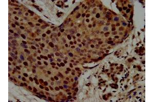 IHC image of ABIN7168396 diluted at 1:500 and staining in paraffin-embedded human pancreatic cancer performed on a Leica BondTM system. (Raly Antikörper  (AA 254-306))