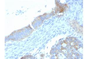 Formalin-fixed, paraffin-embedded human Colon Carcinoma stained with Heparan Sulfate Monoclonal Antibody (SPM255). (HSPG2 Antikörper)