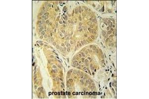 EN Antibody (C-term) (ABIN652020 and ABIN2840500) immunohistochemistry analysis in formalin fixed and paraffin embedded human prostate carcinoma followed by peroxidase conjugation of the secondary antibody and DAB staining. (Enamelin Antikörper  (C-Term))