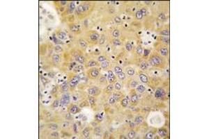 Formalin-fixed and paraffin-embedded human hepatocarcinoma tissue reacted with AARS antibody (N-term), which was peroxidase-conjugated to the secondary antibody, followed by DAB staining. (AARS Antikörper  (N-Term))