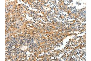 The image on the left is immunohistochemistry of paraffin-embedded Human tonsil tissue using ABIN7129267(DTX3 Antibody) at dilution 1/20, on the right is treated with fusion protein.