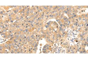 Immunohistochemistry of paraffin-embedded Human breast cancer tissue using S100A12 Polyclonal Antibody at dilution 1:45 (S100A12 Antikörper)