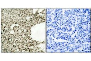 Immunohistochemical analysis of paraffin-embedded human breast carcinoma tissue using STAT1 (phospho- Ser727) antibody (E011163). (STAT1 Antikörper  (pSer727))