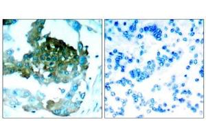 Immunohistochemical analysis of paraffin-embedded human lung carcinoma tissue, using PKCθ (Ab-695) antibody (E021185). (PKC theta Antikörper)