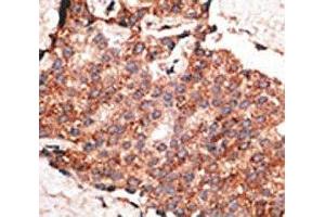 IHC analysis of FFPE human breast carcinoma tissue stained with the BMP1 antibody (BMP1 Antikörper  (AA 957-986))