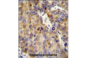 COL18A1 Antibody immunohistochemistry analysis in formalin fixed and paraffin embedded human hepatocarcinoma followed by peroxidase conjugation of the secondary antibody and DAB staining. (COL18A1 Antikörper  (AA 1311-1339))