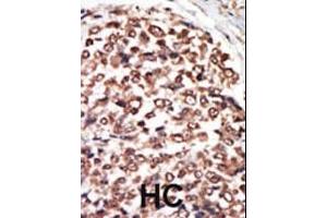 Formalin-fixed and paraffin-embedded human cancer tissue reacted with the primary antibody, which was peroxidase-conjugated to the secondary antibody, followed by AEC staining.