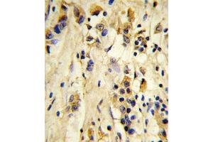 Formalin-fixed and paraffin-embedded human breast carcinoma reacted with EIF4E2 Antibody, which was peroxidase-conjugated to the secondary antibody, followed by DAB staining. (EIF4E2 Antikörper)